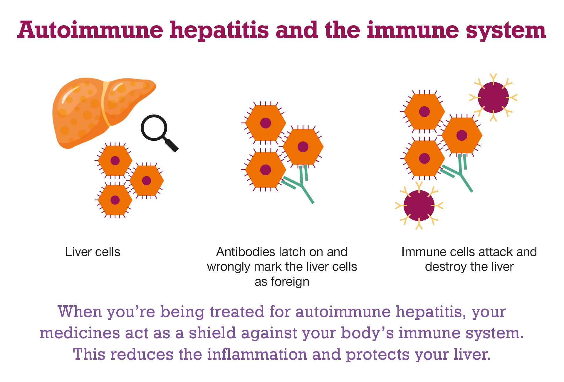 Image title is: autoimmune hepatitis and the immune system. Under this are 3 diagrams. The first shows a liver and 3 representations of liver cells, a magnifying glass shows that these cells are being shown enlarged compared to the liver. The cells are shown as orange hexagons with a dot in the middle and spikes on the outside. This diagram is labelled liver cells. The second diagram shows 3 of the cells. A green Y shaped structure representing an antibody is stuck to the spikes on two of the cells. This diagram is labelled: antibodies latch on and wrongly mark the liver cells as foreign. The third diagram also has the image of the cells and antibody. In addition it has two circles, each with several yellow Y shaped structures sticking out of them. These circles represent immune cells. The label for this diagram says: immune cells attack and destroy the liver. Text under the three diagrams reads: When you're being treated for autoimmune hepatitis, your medicines act as a shield against your body's immune system. This reduces the inflammation and protects your liver. 