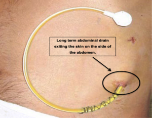 The image shows the side of someone's tummy. There is a small yellow tube coming out of the tummy with some stiches over the first part of it. Once outside it is coiled round to form most of a circle, ending in a white patch that holds to end to the skin. An arrow points to where the tube comes out with text that says, "long term abdominal drain exiting the skin on the side of the abdomen"